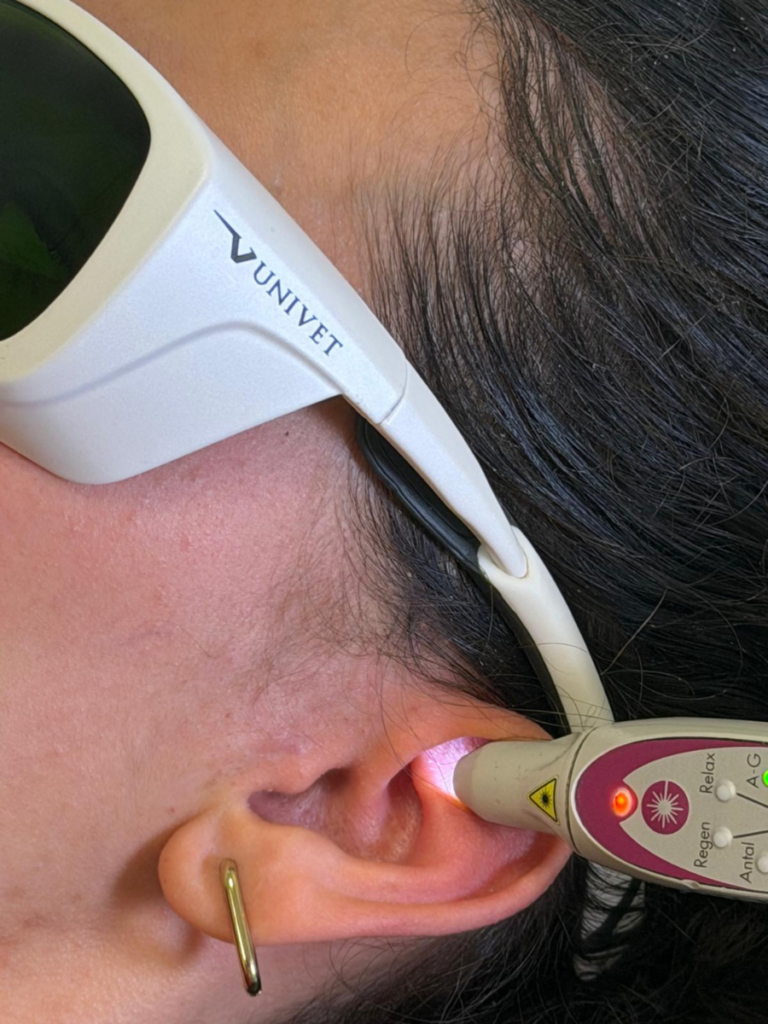 Application du laser doux sur les points du pavillon de l'oreille